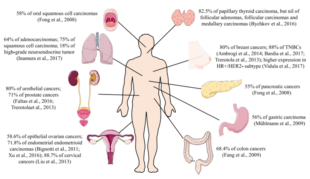 图2. Trop 2在肿瘤中的过表达，来源：参考资料1